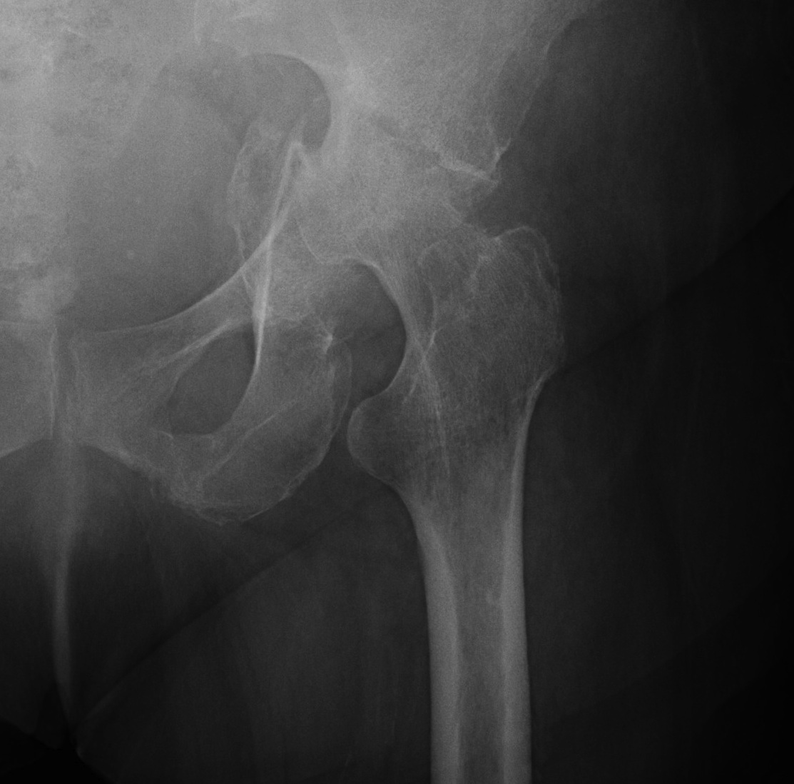 Hip OA post displaced Acetabular Fracture